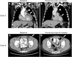 Change in bowel or bladder habits: In This Issue Research Watch News In Brief News From The Iaslc Tobacco Control Committee Journal Of Thoracic Oncology