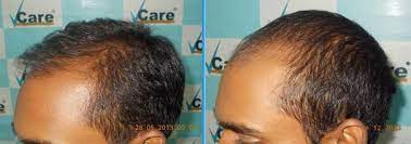 Vcare stem cell therapy for hair treatments Testimonials India S Most Trusted Hair Care Brand Vcare