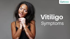 Image result for Vitiligo