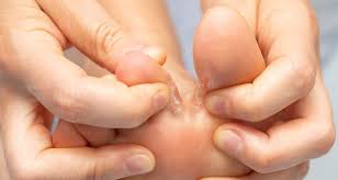 The lower extremity of the vertebrate leg that is in direct contact with the ground in. Athlete S Foot Tinea Pedis Symptoms Causes Treatment Prevention