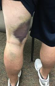 Those athletes particularly vulnerable are competitors involved in sports that require a high degree of. Tendon Disorders Of The Hip And Thigh Orthopaedia