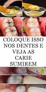 Carie Dentaria Como Eliminar As Caries Com Apenas Essa Receita Sante Et Beaute Sante Sante Beaute