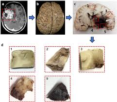 You may get a fleeting loss of vision lasting a few seconds ('greying out') related to changes in your posture, such as suddenly standing up. Diffusion Histology Imaging Differentiates Distinct Pediatric Brain Tumor Histology Scientific Reports