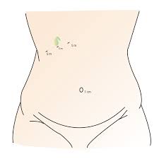 Scalpel ● which tool is used for ileus? Laparoscopic Cholecystectomy Gallbladder Surgery Kochi Lakeshore