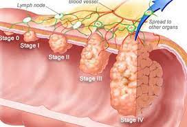 This includes for some, there is a beginning and end to their colon cancer treatment. Colon Cancer Symptoms Survival Rate Treatment Stages