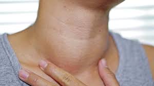 Does problem with the lymph nodes always mean cancer? Enlarged Lymph Nodes After Covid 19 Vaccination Could Be Mistaken For Cancer Technology News Firstpost