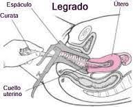 El legrado uterino, también denominado raspado uterino, es una intervención ginecológica que sirve para extraer parte de la capa interna del útero, el endometrio. Que Es El Legrado Uterino Instrumental Dilatacion Y Legrado