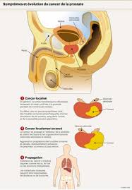 In fact, most people don't even know what it does. Le Cancer De La Prostate Peut Longtemps Passer Inapercu Planete Sante