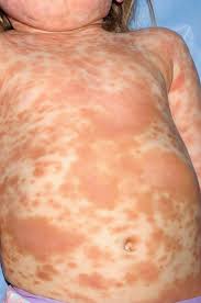 Image result for Urticaria pigmentosa children