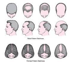 If You Are Suffering Form Situational Baldness Genetic Baldness Or Male Female Pattern Baldness Than You W Hair Loss Men Reverse Hair Loss Hair Loss Treatment