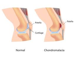 Chondromalacia Patella | Orthopaedic Associates Of St. Augustine