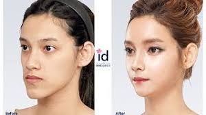 Top Plastic Surgery Clinic In Bangkok Thailand V Plast Clinic Plastic Surgery Korean Plastic Surgery Facial Bones
