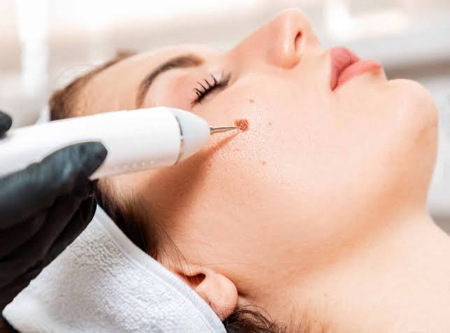 Pros And Cons Of Mole Removal - Perfect Doctors Clinic