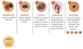 All of these are the symptoms of melanoma. Annual Skin Cancer Screening Dermatologist Spring Texas Houston Katy