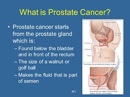 If signs are pointing to prostate cancer, tests will be done. Prostate Cancer Education Outreach Ppt Video Online Download
