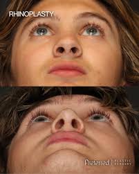 Loving this stunning on-the-table transformation! This revision rhinoplasty  beautifully refined our patient's profile while preserving a natural look.  Can't wait to share her healing journey — stay tuned! ⁠ 📍 Tahoe Facial