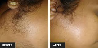 To reduce any discomfort, apply ice to the treated area. The Benefits Of Laser Hair Removal St Louis Cosmetic Surgery Reviews