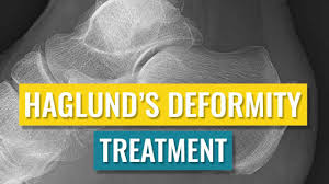 Schneider w., niehus w., knahr k. Haglund S Deformity Treatment Youtube