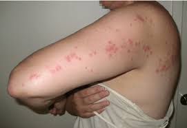 Image result for Cimex lectularius bites