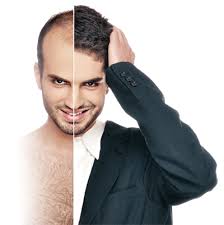 زراعة الشعر للرجال بالصور و كيفية إجراء العملية والاسعار Hair Transplant In India Cheap Hair Products Hair Restoration