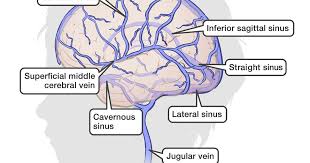 Blood clots can reduce the flow of blood throughout your body. Childhood Stroke Cerebral Sinovenous Thrombosis Csvt