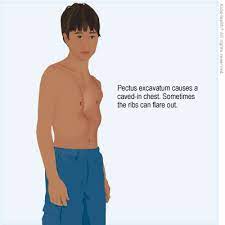 Pectus excavatum genetics and associated syndromes. Chest Wall Disorder Pectus Excavatum For Parents Nemours Kidshealth