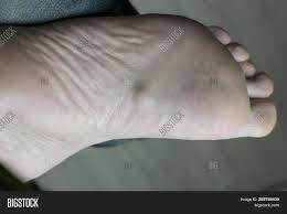 A distinguishable gap or lump can be felt at the site of the fracture. Plantar Fibromatosis Image Photo Free Trial Bigstock