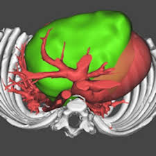 3D images aid selection of heart transplant donors