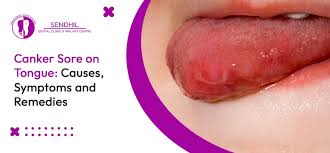 Image result for Canker sores roof of mouth
