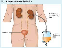 Nursing Care And Management Of Patients With A Nephrostomy Nursing Times