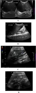 Learn step 2 and shelf essentials in a free 10 min video. A Ultrasound Of The Abdomen Showed Bilateral Pleural Effusion More At Download Scientific Diagram