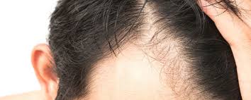 Had been using it since the start of the year but i got a shed on my temples and hairline, although that may not have been shedding from minoxidil, it may have just been natural hairloss. Minoxidil Your Questions Answered Limmer Hair Transplant Center