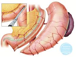 Sleeve Gastrectomy Gastric Sleeve Brisbane Obesity Clinic