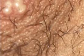 Folliculitis is a common skin condition in which hair follicles become inflamed. Ingrown Hair Bump