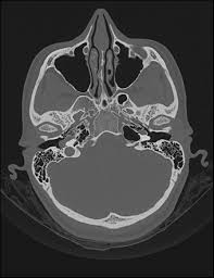 A ringing, swishing, or other noise in the ears or head when no external sound is present is called tinnitus. Pulsatile Tinnitus Radiology Reference Article Radiopaedia Org