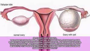 Kamu mungkin agak skeptis membacanya, but let. Ketahui Tanda Tanda Anda Fibroid Dan Cyst Dalam Rahim Pesona Pengantin