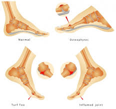 Turf toe is a sprain of the fibrous joint capsule that supports the metatarsophalangeal (mtp) joint at the base of the big toe. Turf Toe Physiopedia