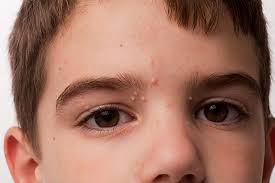 Image result for yellow scabs on the face in children