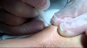 What's the cost of facial electrolysis? Electrolysis Hair Removal On The Female Face Youtube