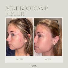 Those “tiny little bumps” can be easily treated just by using a cleanser  with salicylic acid! 🌟 Let me know if you guys want more of these info  charts! I love making