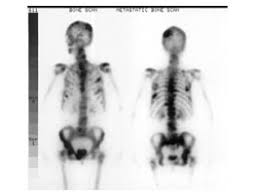 If this occurs, you will be told you have metastases, metastatic cancer, or stage 4 (iv) cancer. Bone Metastases When Cancer Spreads To The Bones Saint Luke S Health System
