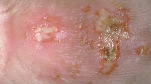 Often people mistakes between genital warts, ingrown hairs and herpes rashes. Is It Herpes Or Something Else Everyday Health