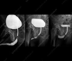 Image result for Voiding Cystourethrogram