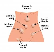 Image result for stomach hernia symptoms