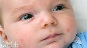 أنواع الطفح الجلدي الشائعة عند الأطفال بالصور ويب طب