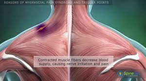 Dantrolene Cured My Myofascial Pain Syndrome Central Sensitivity Syndrome A Survivor S Guide