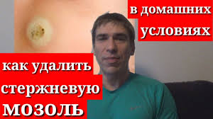 как вывести сухой мозоль со стержнем на пальце ноги Sterzhnevaya Mozol Kak Udalit V Domashnih Usloviyah Youtube
