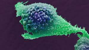 Earlier this year, in january of 2020, i had surgery to remove the cancer. Science Talk Prostate Cancer Awareness Month 2020 Immunotherapy State Of The Art Radiotherapy Olaparib And Psa Screening The Institute Of Cancer Research London