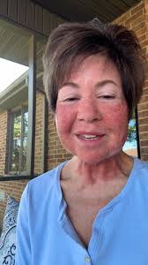 The day after and no regrets! Wendy is making great healing progress  following her laser face and neck resurfacing with Dr. Lesley Hawley  yesterday. , While Ozarks Dermatology Specialists has been ...