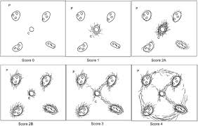 Image result for Fibrosis Probability Score
